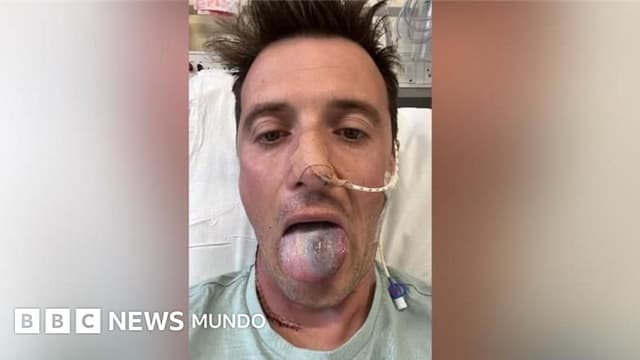 Casi pierdo la lengua por un cáncer y ahora alerto a otros hombres sobre el riesgo del virus del papiloma humano