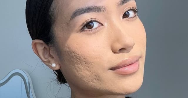 Cómo tapar el acné correctamente: tips de maquillaje que sí funcionan