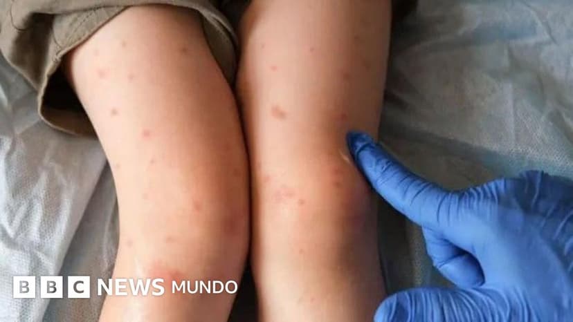 El condado en EE.UU. donde el sarampión comienza a sentirse como la nueva pandemia